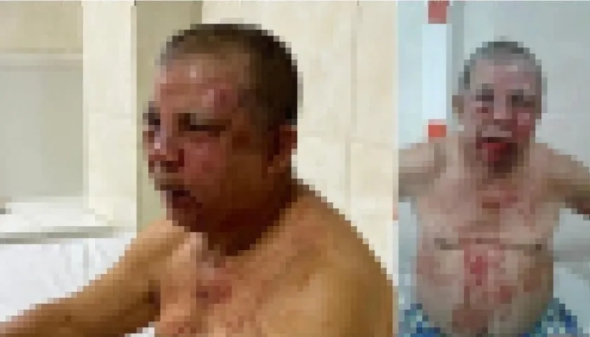 Con golpes en su cara quedó el comerciante Dagoberto Sierra en Luruaco.