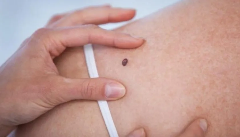 Esos "patito feo" puede acabar en melanoma.