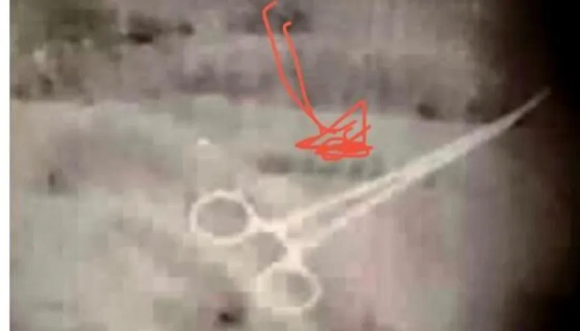 Radiografía de la pinza quirúrgica en el cuerpo del paciente.