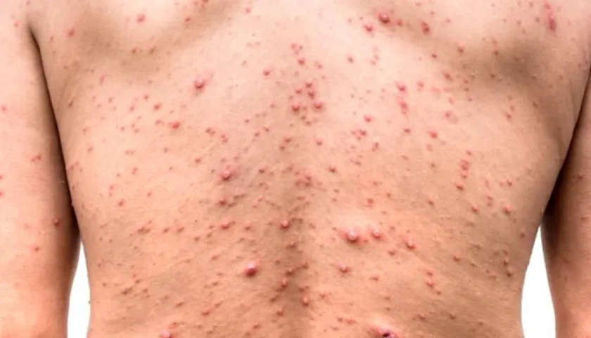 Efectos de la viruela del mono.