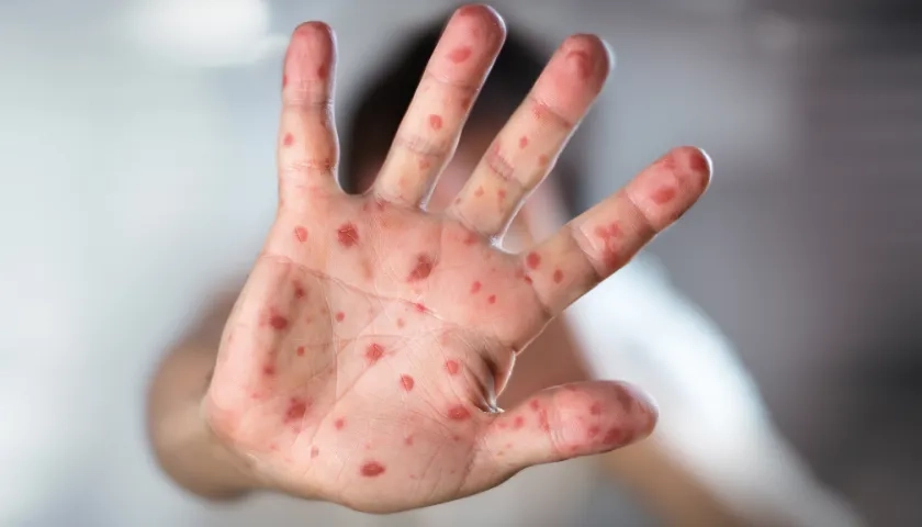 Imagen de referencia de sarampión.