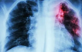 La fibrosis pulmonar hace que el tejido del pulmón desarrolle cicatrices.