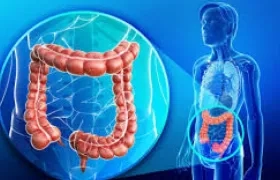 Ilustración de cáncer colorrectal.