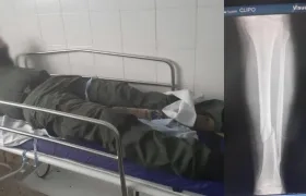 El uniformado cuando recibía atención médica en la Clínica de la Policía y donde se muestra la fractura en su pierna.