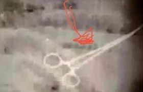 Radiografía de la pinza quirúrgica en el cuerpo del paciente.