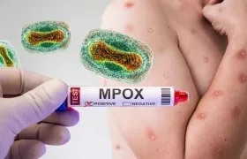 Mpox. 