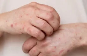 Imagen de referencia de sarampión.
