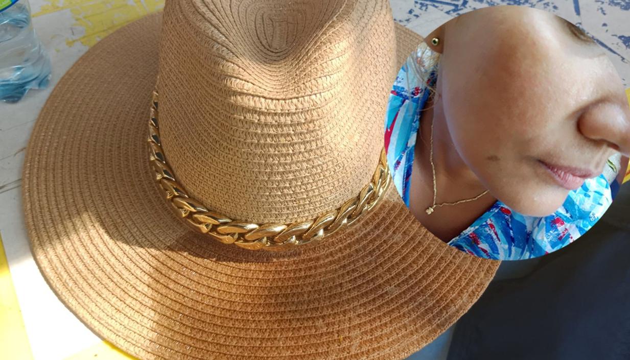 La mujer agredida muestra la zona afectada