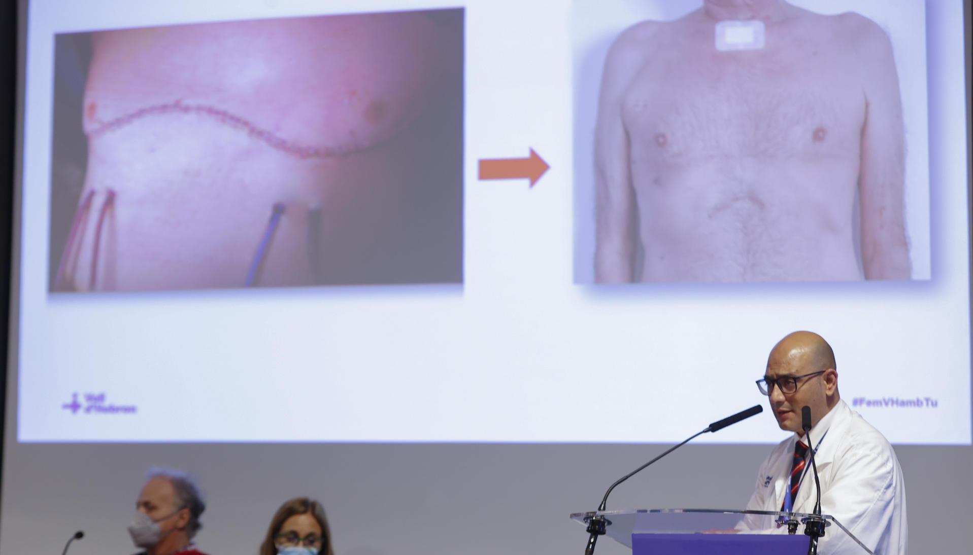 Todo un éxito el primer transplante pulmonar robótico 