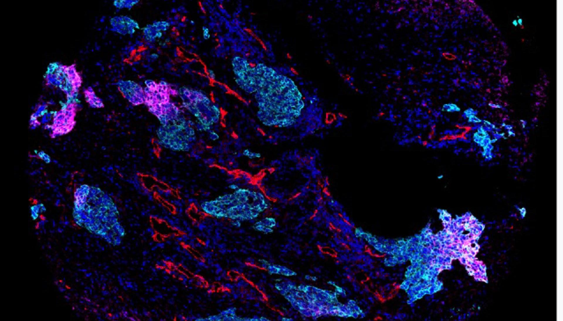 Imagen cedida de células tumorales de cáncer de pulmón