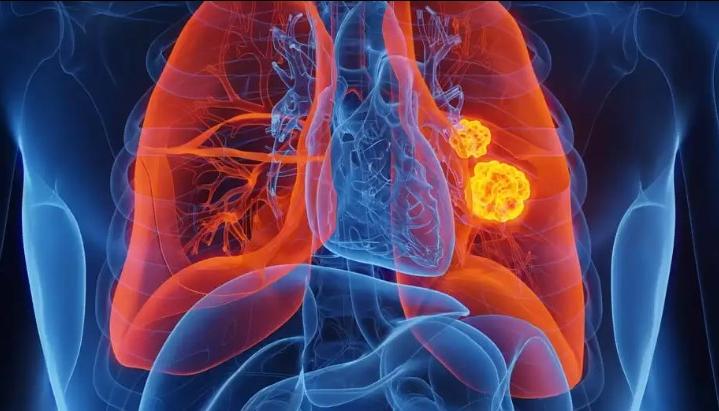 El cáncer de pulmón es la primera causa de muerte por cáncer a nivel mundial 