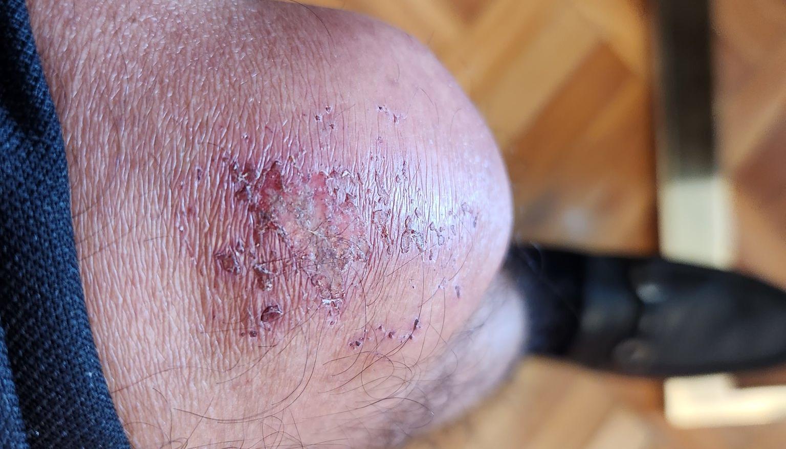 Así quedó la rodilla del Presidente Gustavo Petro.