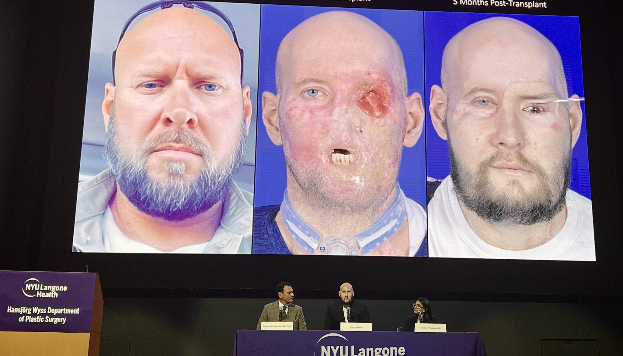 Los especialistas explican el procedimiento en el paciente Aaron James