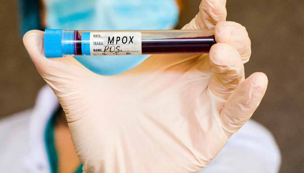 Prueba de sangre para detectar Mpox.