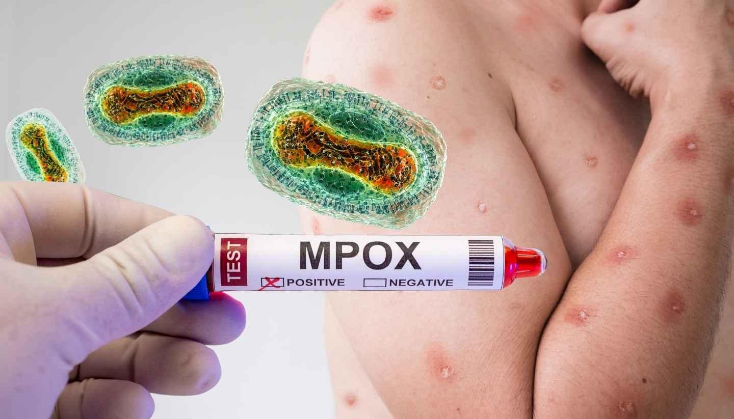 Mpox. 