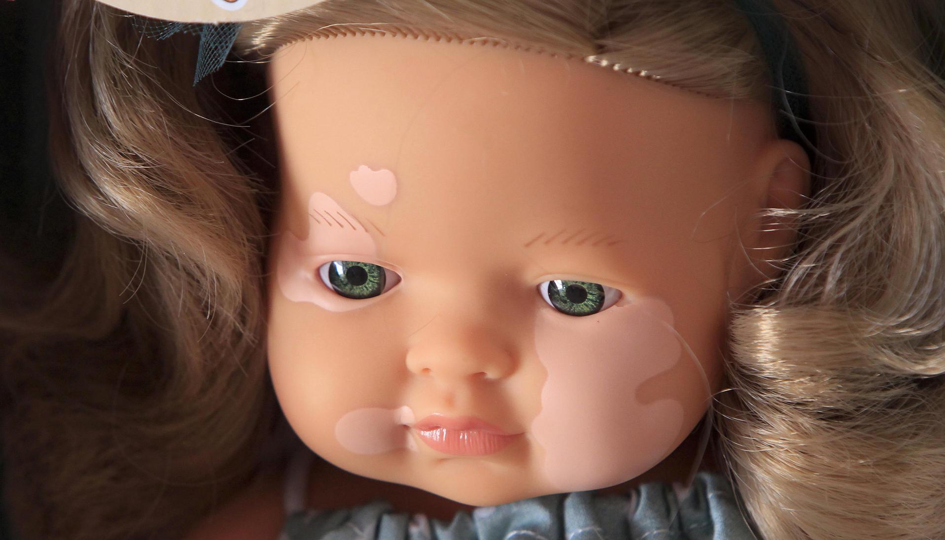 Muñeca con vitíligo. 