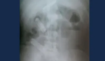 En la imagen de este rayos X se observan los celulares en el estómago del recluso.