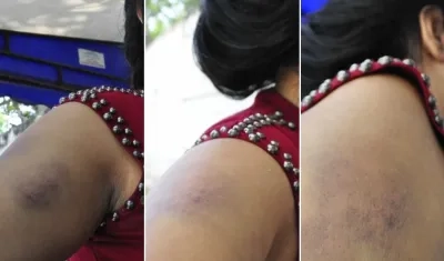La mujer muestra los golpes recibidos.
