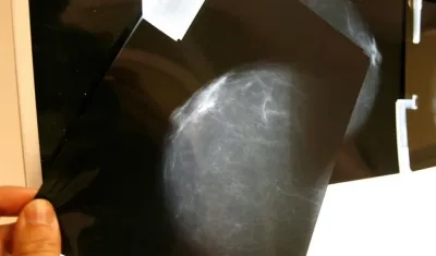 Detectado a tiempo el cáncer de seno es curable hasta en un 98 % de los casos.