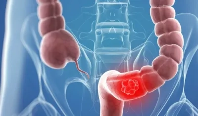 Todavía no está demostrado los vínculos directos entre nutrientes, inflamación y cáncer colorrectal.