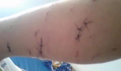 Así quedó el brazo del menor.