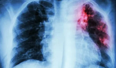 La fibrosis pulmonar hace que el tejido del pulmón desarrolle cicatrices.