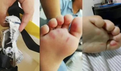 Así quedaron zapato y pies del niño.
