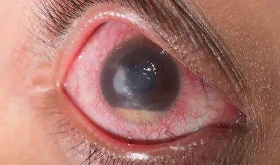 El glaucoma es silencioso por eso muchas veces no se detecta a tiempo.