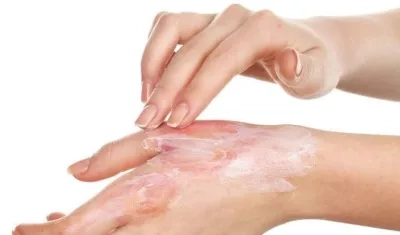 Lo recomendable es solo aplicar agua en la zona afectada.