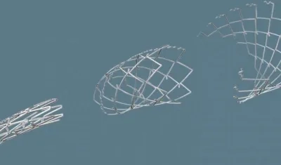  Este es el "Begrow-Stent" implantado a la paciente.