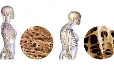 Este padecimiento afecta a una de cada tres mujeres y a uno de cada cinco varones mayores de 50 años.