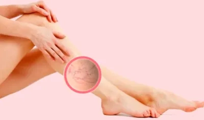 Ilustración várices