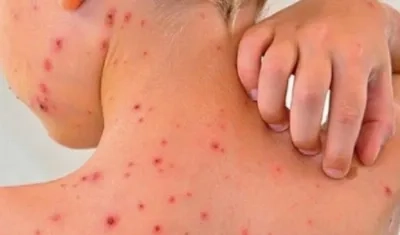 El instituto agregó que actualmente estudian 157 casos sospechosos de sarampión.