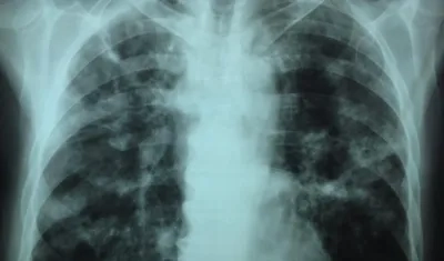 Los reclusos aportan el 7,0% de la notificación de tuberculosis en Colombia.