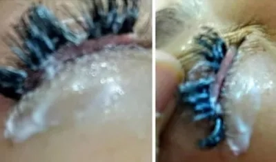 Mujer afectada por goma tóxica en sus pestañas.