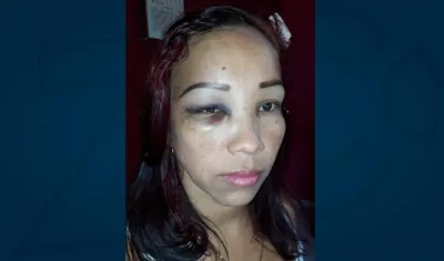 Así quedó el rostro de Cindy Anguila. La mujer autorizó a publicar la foto.