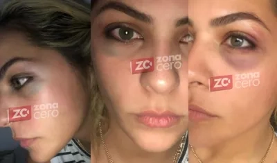 Los golpes que sufrió Laura Ojeda Estupiñán.