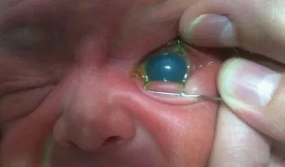 Durante el primer año de vida se llama glaucoma congénito.