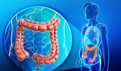 Ilustración de cáncer Colorrectal. 