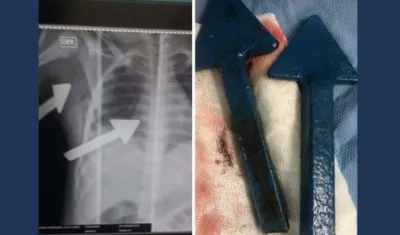 Radiografía del menor y rejas incrustadas en su cuerpo.