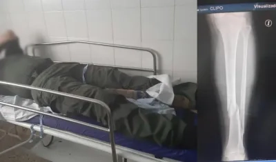 El uniformado cuando recibía atención médica en la Clínica de la Policía y donde se muestra la fractura en su pierna.