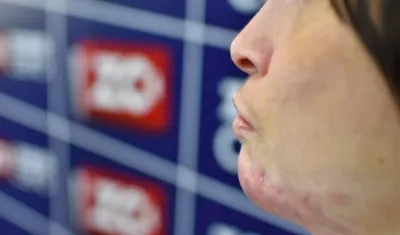 La quemadura que sufrió María Elizabeth en su mentón.