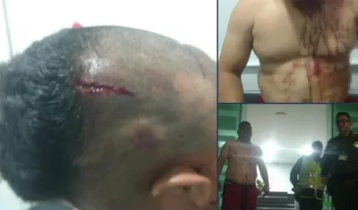 Dixon González, expatrullero de la Policía, muestra sus heridas.