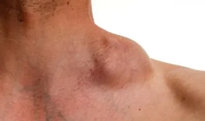  El linfoma es un cáncer que se encuentra en la sangre por ello está en todo el cuerpo y no se puede operar para contrarrestarlo como sucede en otros tipos.