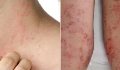 Esta enfermedad aparece desde el primer mes de vida.