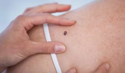 Esos "patito feo" puede acabar en melanoma.