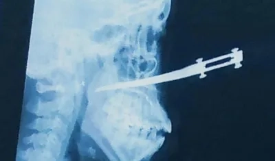 Radiografía de cómo le quedó enterrado el cuchillo en el rostro de la mujer. 