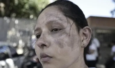 Vilma recibió quemaduras en parte de su rostro. 