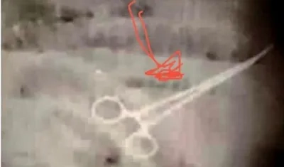 Radiografía de la pinza quirúrgica en el cuerpo del paciente.