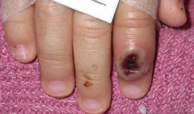 Paciente pediátrico de viruela del mono.